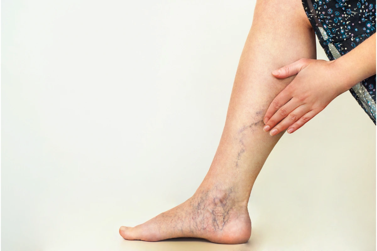 varicose veins treatment near whittier