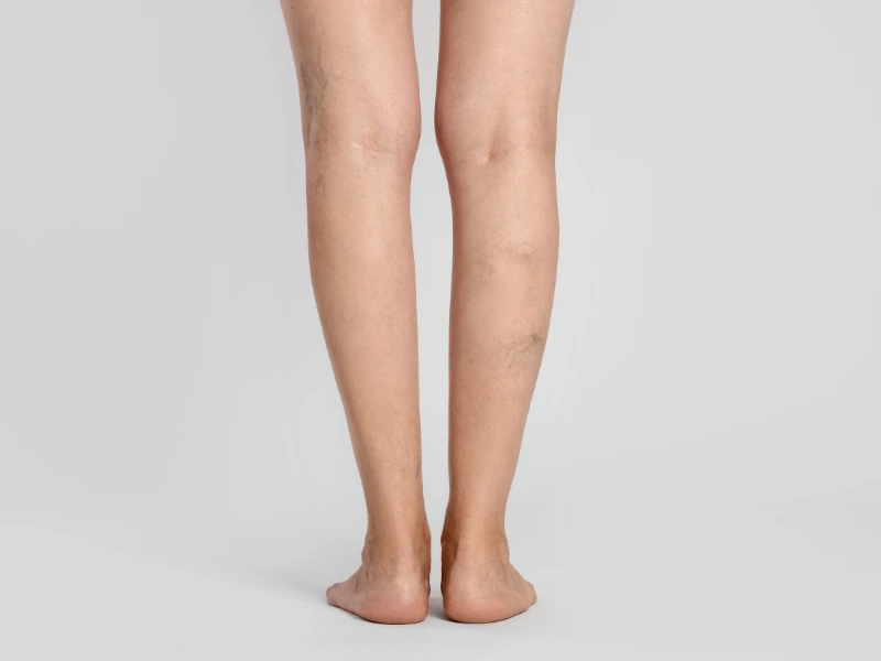 Affordable cost of varicose veins treatment