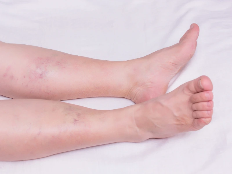 benefits of varicose veins treatment