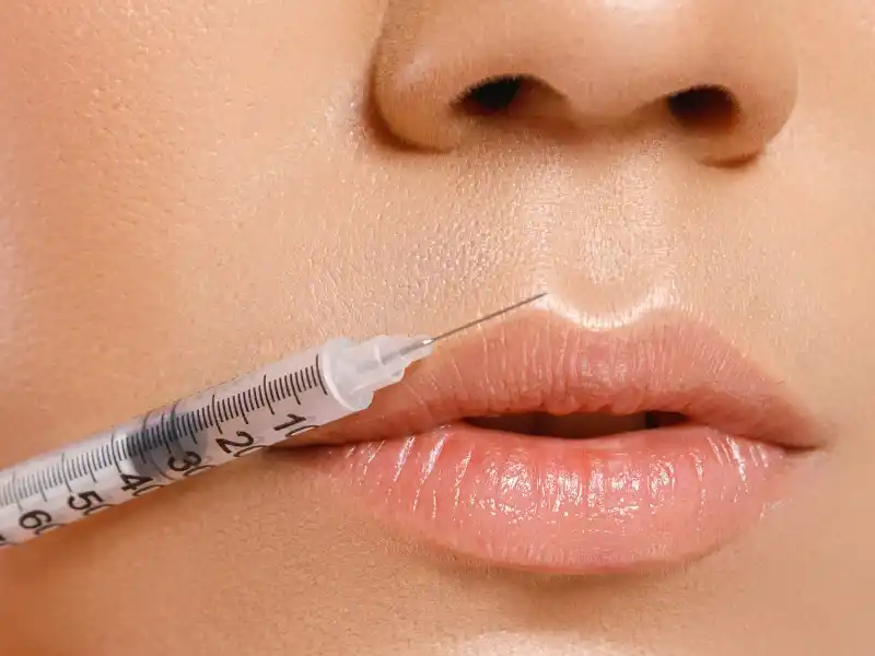 candidates for Lip Fillers