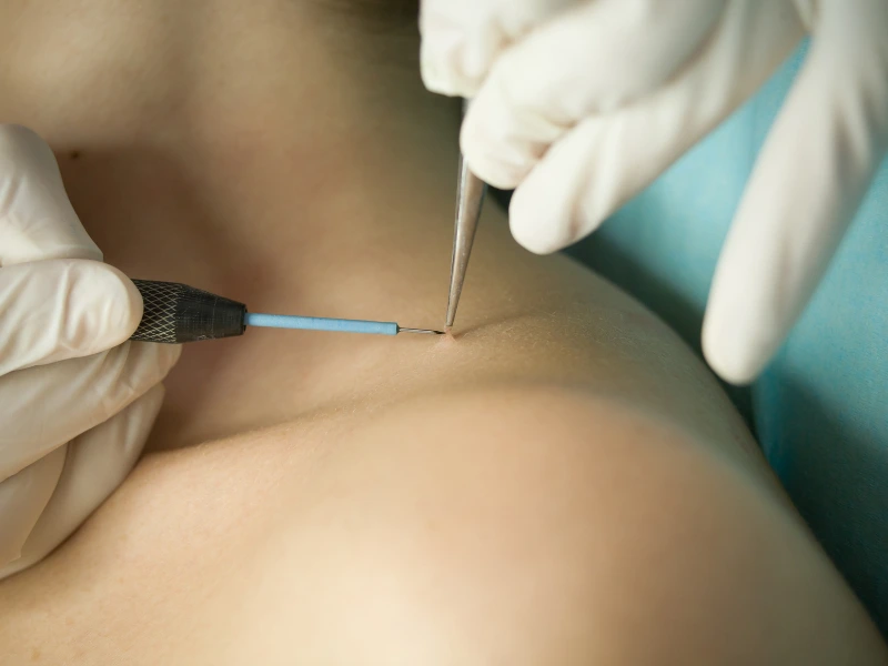 what is skin tags removal